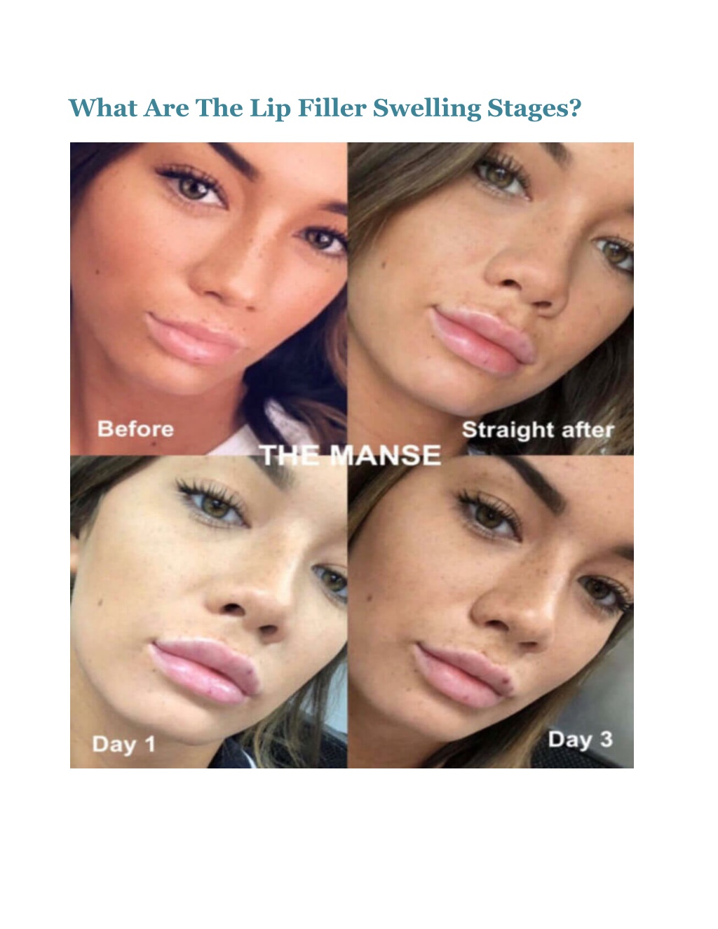 Ppt Lip Filler Swelling Stages In Days All You Need To Know