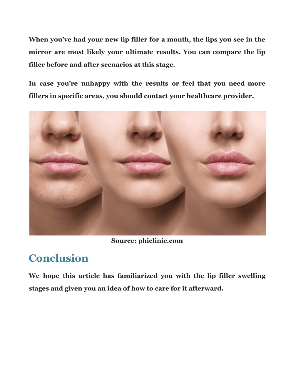 Ppt Lip Filler Swelling Stages In Days All You Need To Know