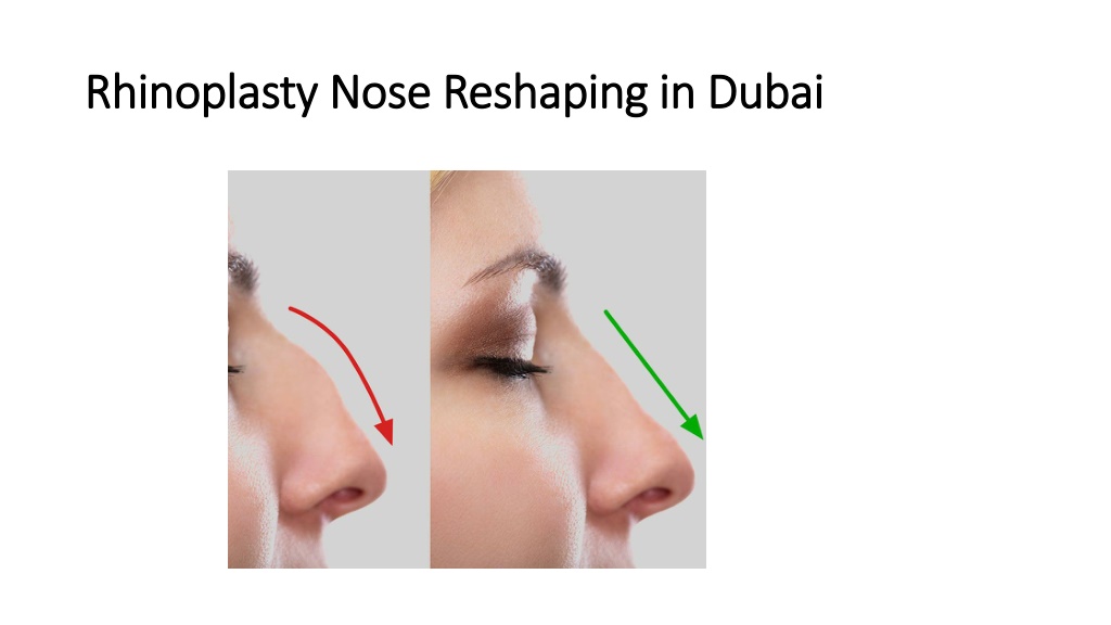 Ppt Rhinoplasty Nose Reshaping In Dubai Powerpoint Presentation Free