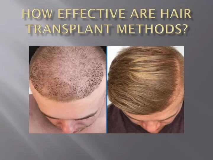 PPT How Effective Are Hair Transplant Methods PowerPoint Presentation