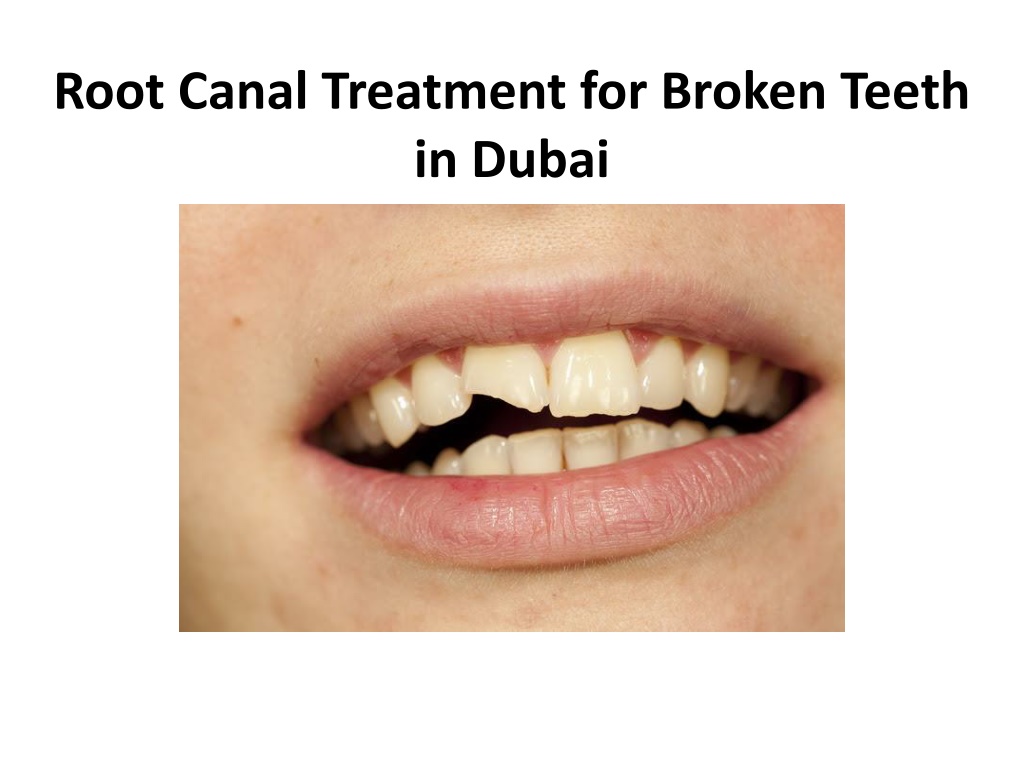 PPT Root Canal Treatment For Broken Teeth In Dubai PowerPoint