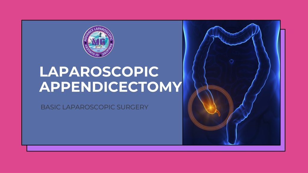 PPT Laparoscopic Appendectomy Surgery In Faridabad PowerPoint