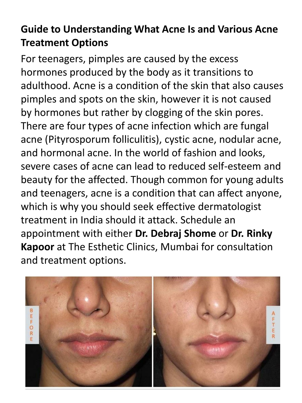 Ppt Pimple And Acne Treatment Guide Powerpoint Presentation Free