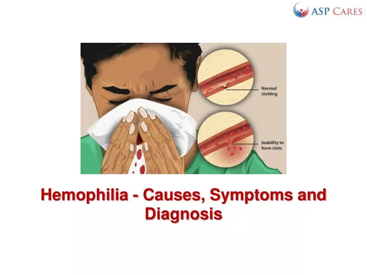 PPT - Hemophilia - Causes, Symptoms And Diagnosis PowerPoint ...