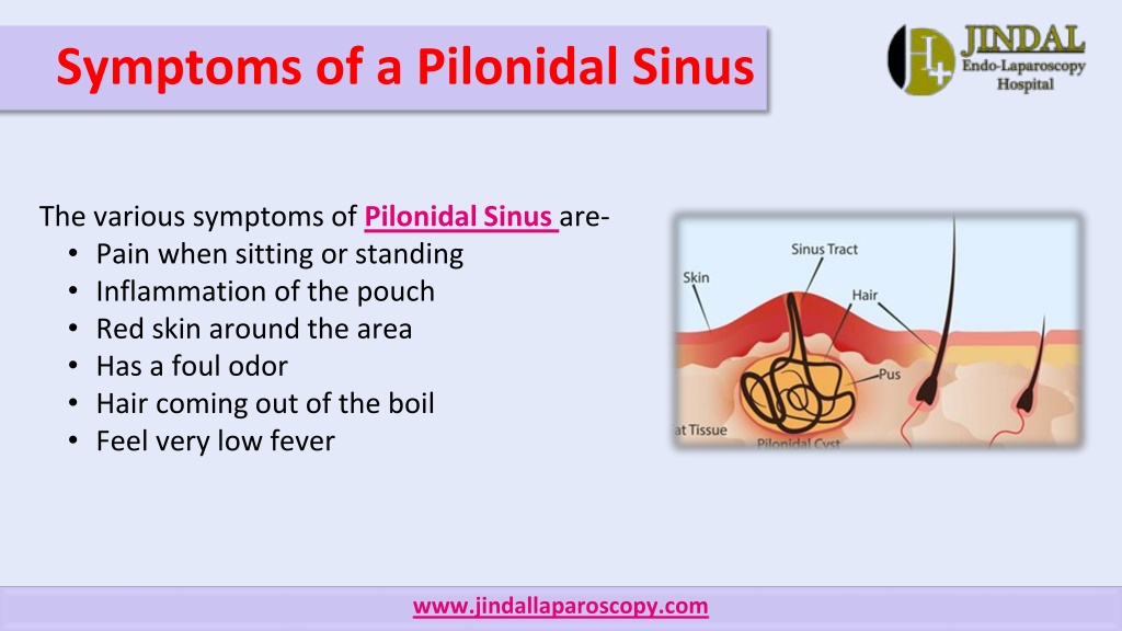 PPT - Best Treatment For Pilonidal Sinus By Jindal Laparoscopy Hospital ...