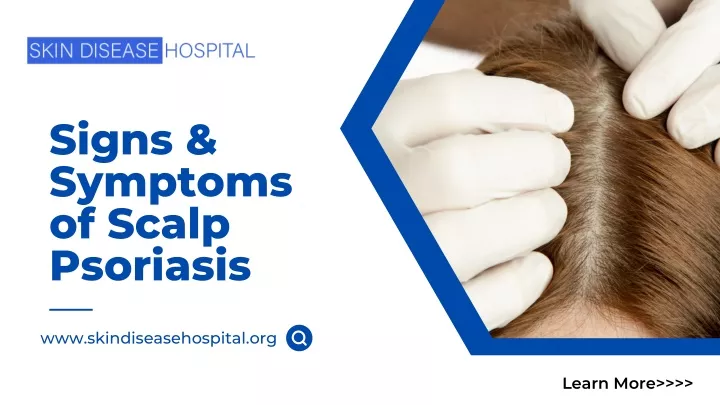 PPT - Signs & Symptoms of Scalp Psoriasis PowerPoint Presentation, free ...