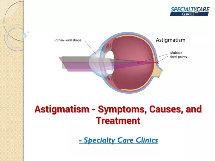 Ppt Astigmatism Symptoms Causes And Treatment Powerpoint