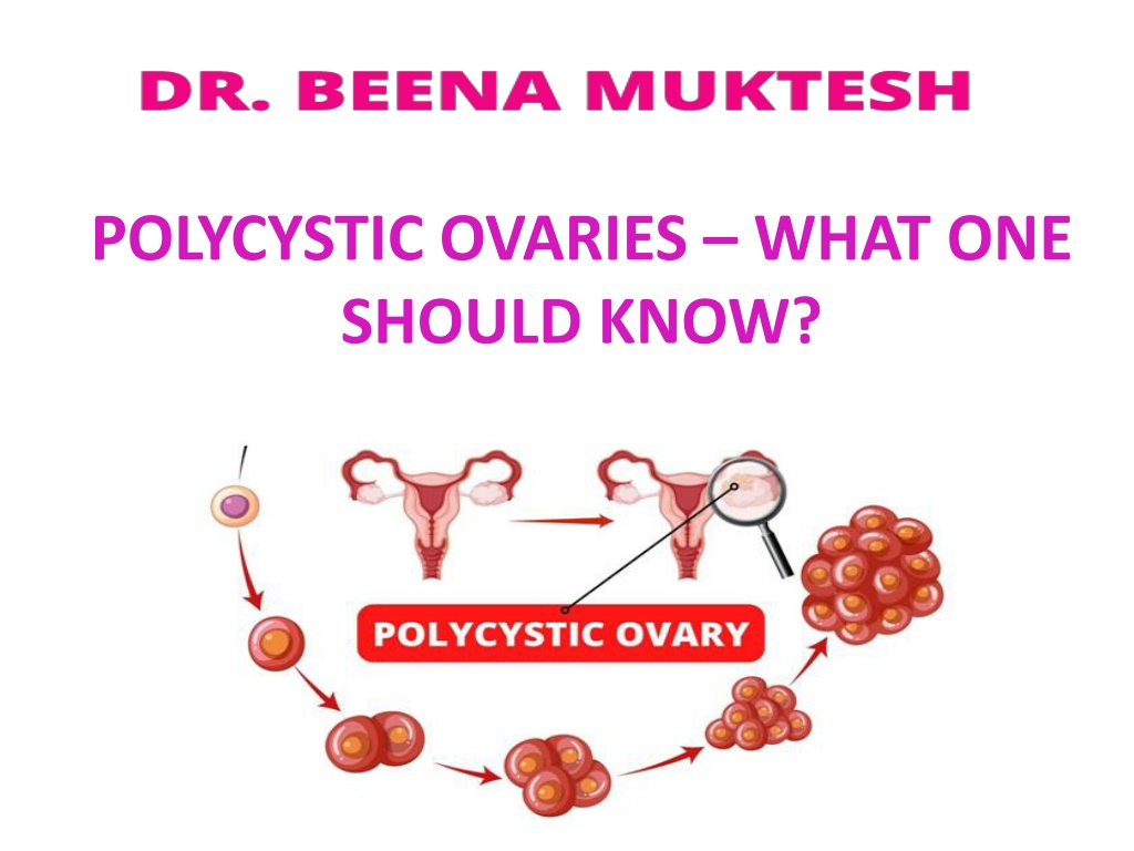 Ppt Polycystic Ovaries What One Should Know Powerpoint Presentation Id11373645 1677