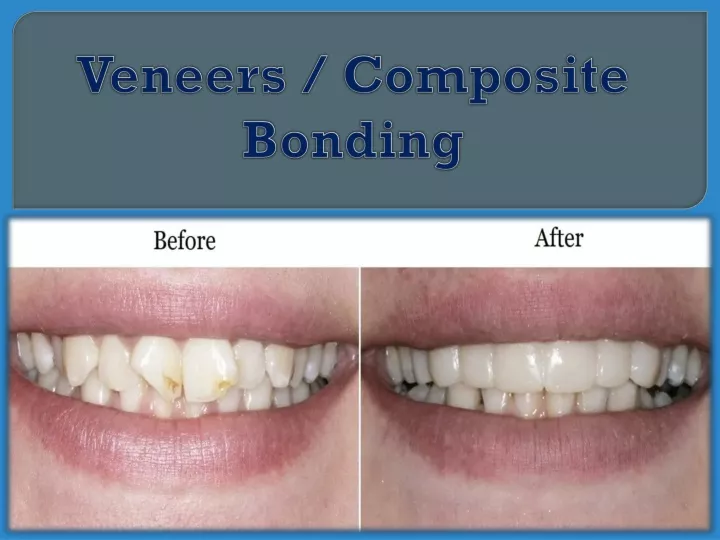 PPT Veneers Composite Bonding PowerPoint Presentation, free download