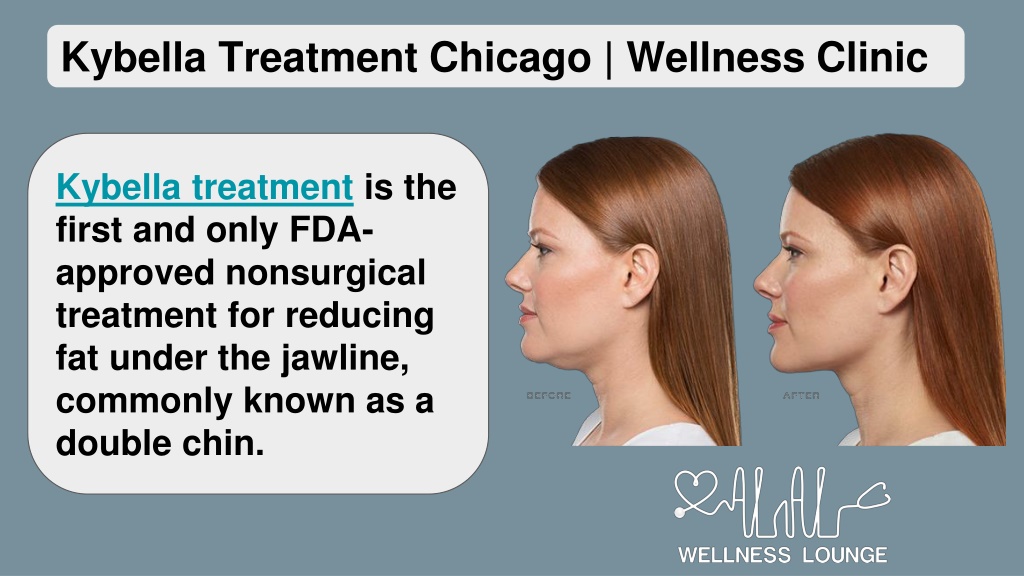 Ppt Kybella Treatment Chicago Alalwellnesslounge Powerpoint Presentation Id11385860 0512