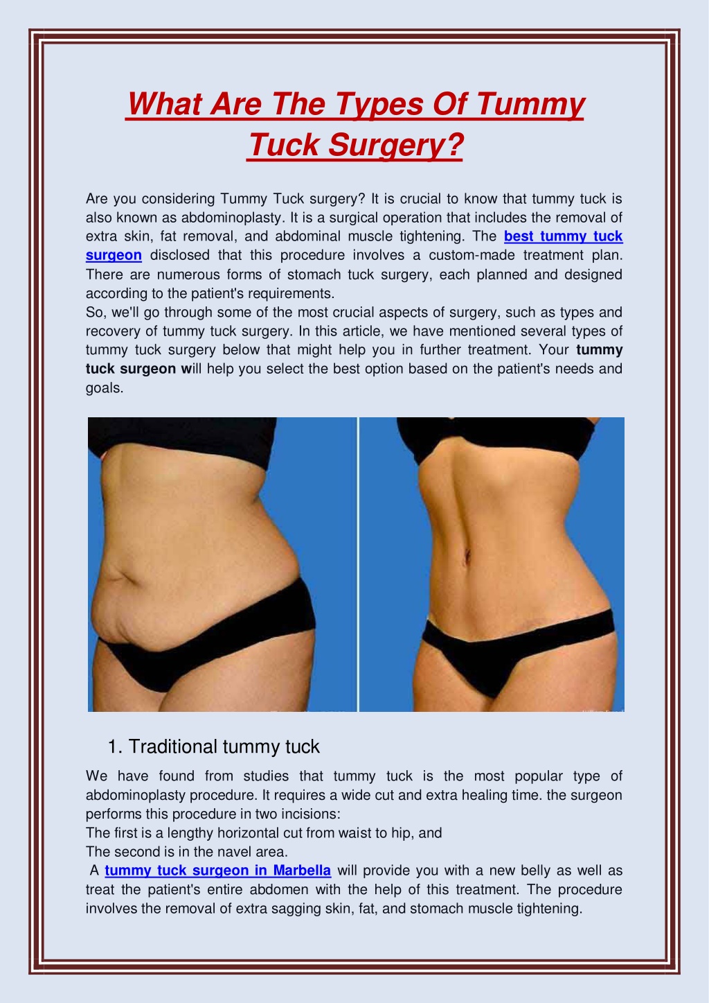 Ppt What Are The Types Of Tummy Tuck Surgery Powerpoint Presentation Id11389018