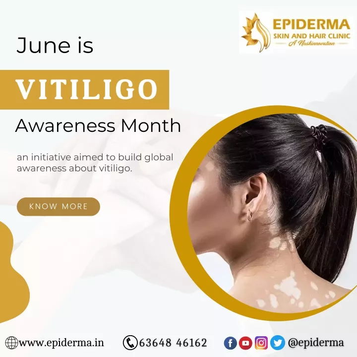 Ppt June Is Vitiligo Awareness Month Best Dermatologist In Jayanagar Epiderma Powerpoint 8024