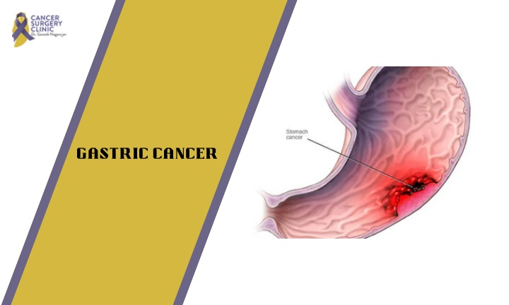 PPT - Surgeon Doctor For Gastric Cancer Treatment PowerPoint ...