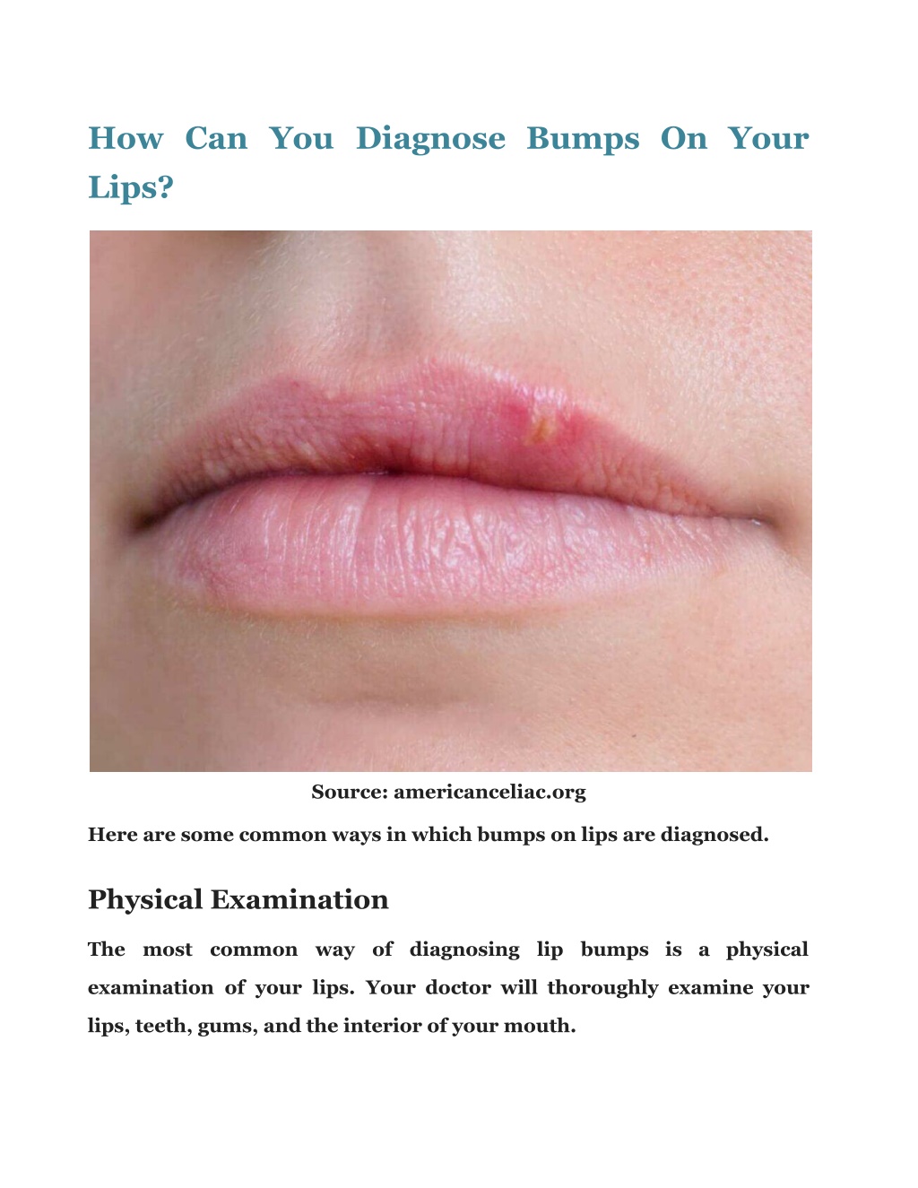 blepharitis-ramsden-opticians