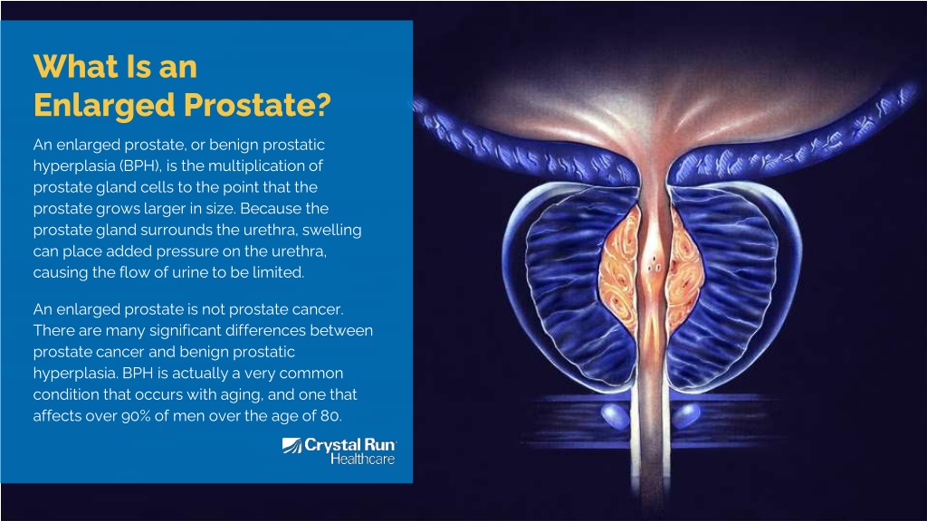 Ppt Enlarged Prostate Causes Symptoms And Treatment Powerpoint Presentation Id