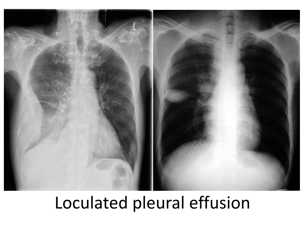 PPT - Pleural Effusion Clinical symptoms and sign - Dr. Sheetu Singh ...