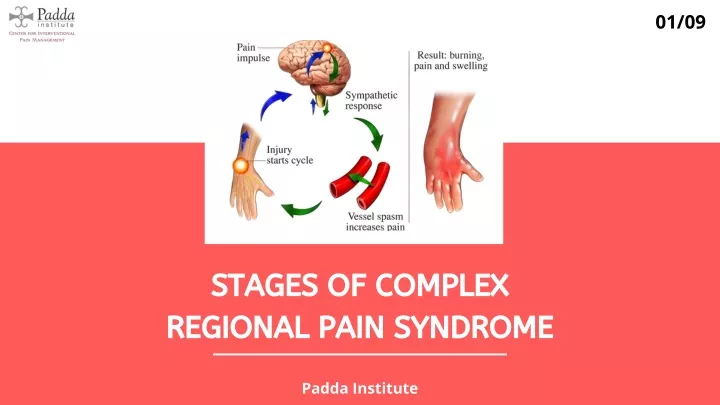 PPT - Stages Of Complex Regional Pain Syndrome PowerPoint Presentation ...