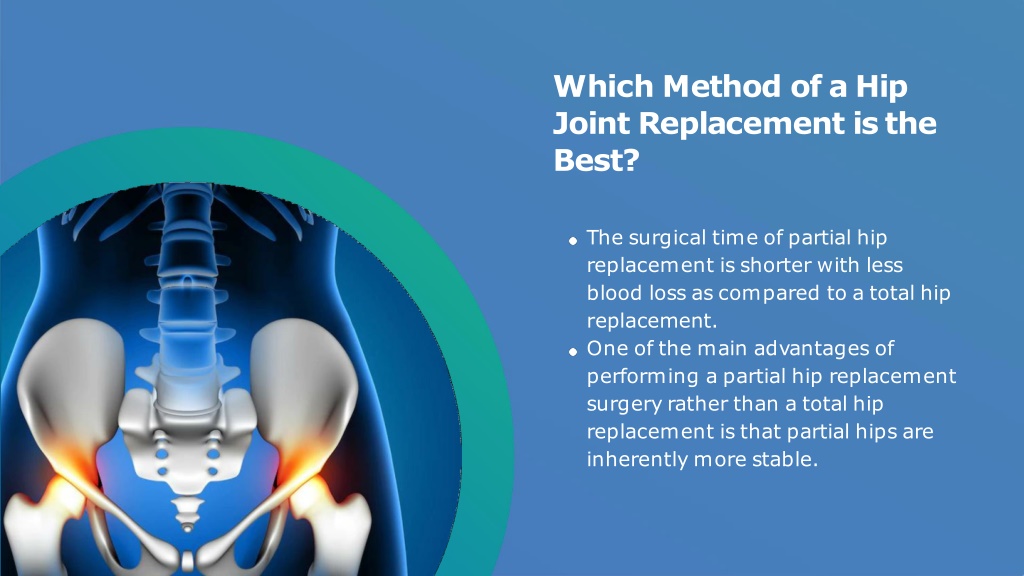 PPT - Partial Vs Total Hip Replacement PowerPoint Presentation, free ...