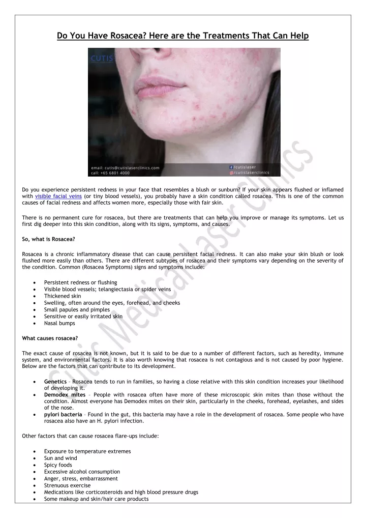 PPT - Do You Have Rosacea? Here are the Treatments That Can Help ...