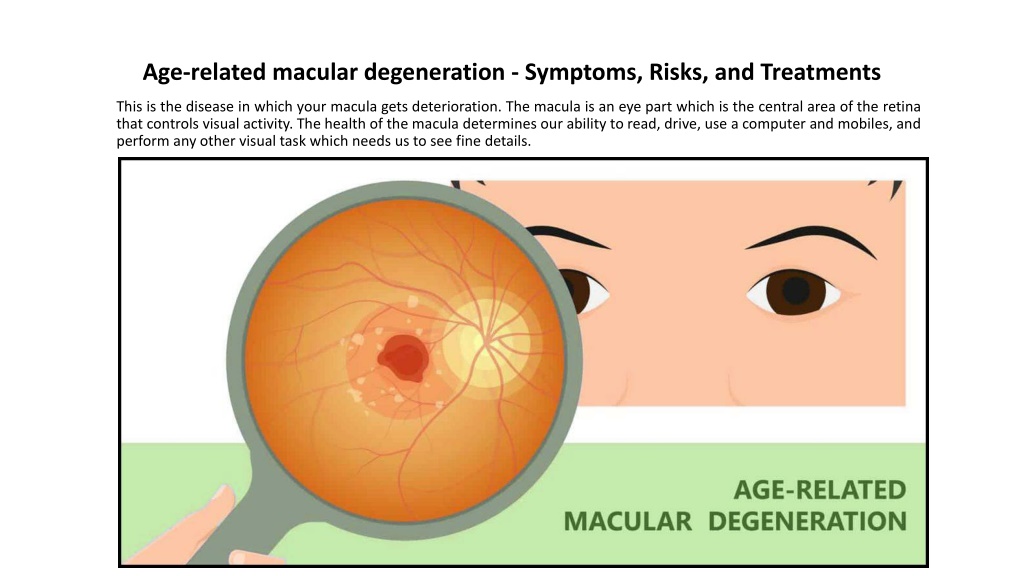 PPT - Age-related macular degeneration - Symptoms, Risks, and ...