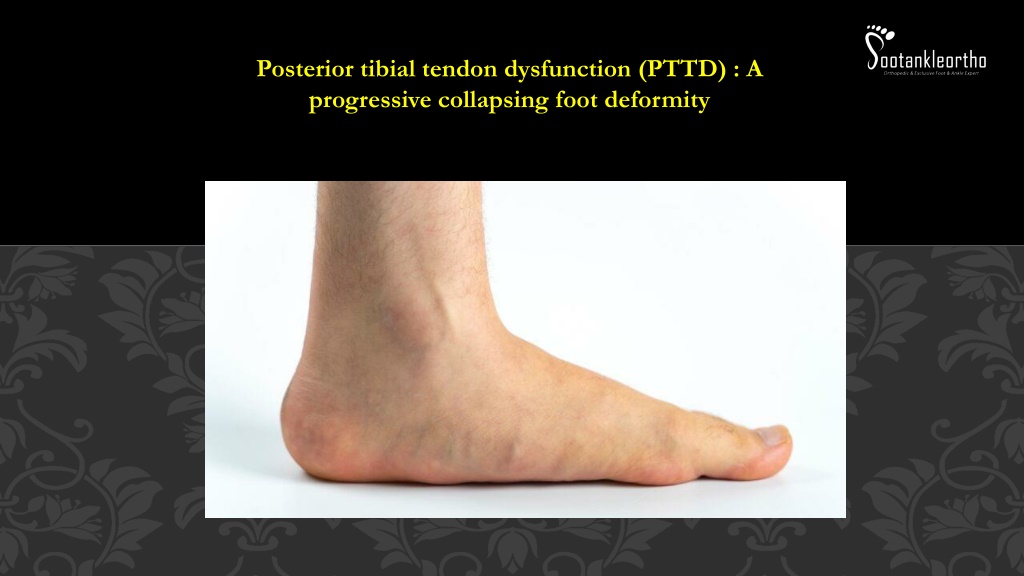 PPT - Posterior Tibial Tendon Dysfunction (PTTD) Footankleortho ...