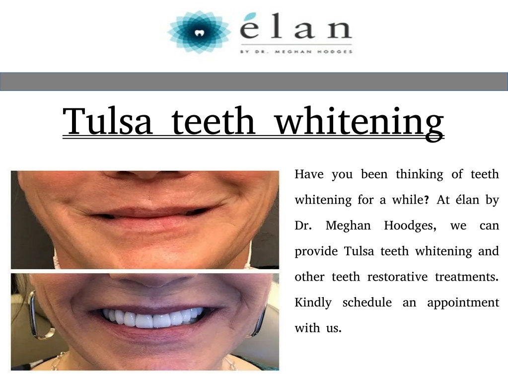 PPT dental veneers tulsa PowerPoint Presentation, free download ID11537853
