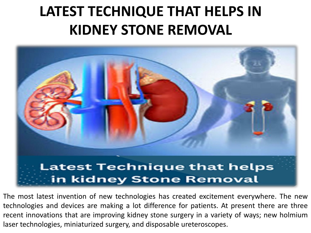 PPT - The Most Recent Kidney Stone Removal Procedure PowerPoint ...