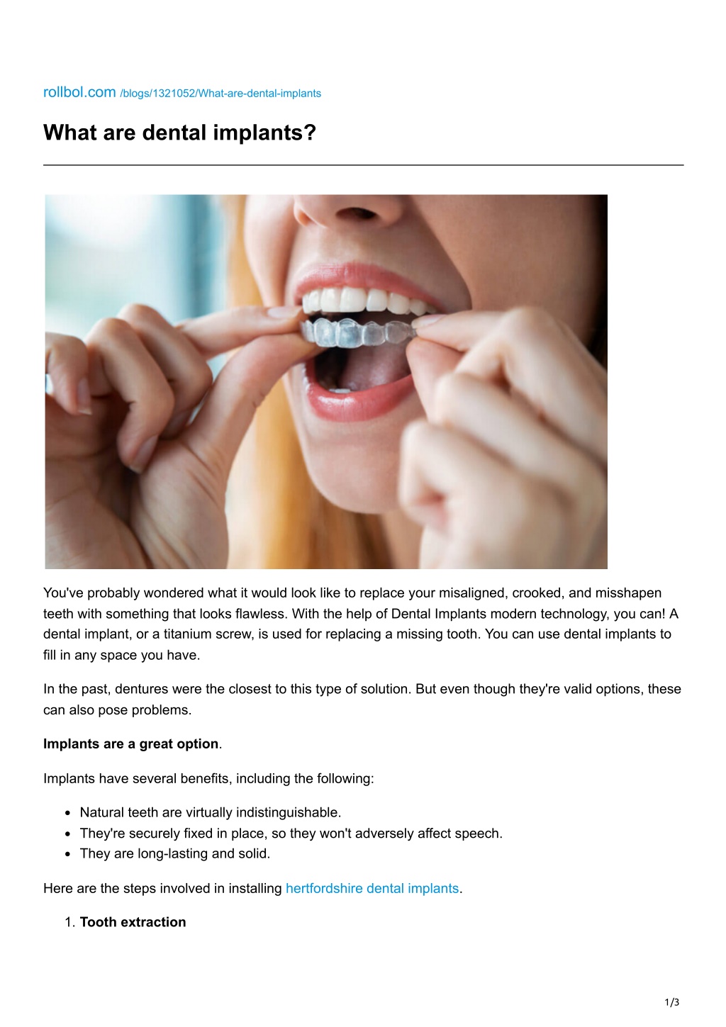 PPT - What are dental implants PowerPoint Presentation, free download ...