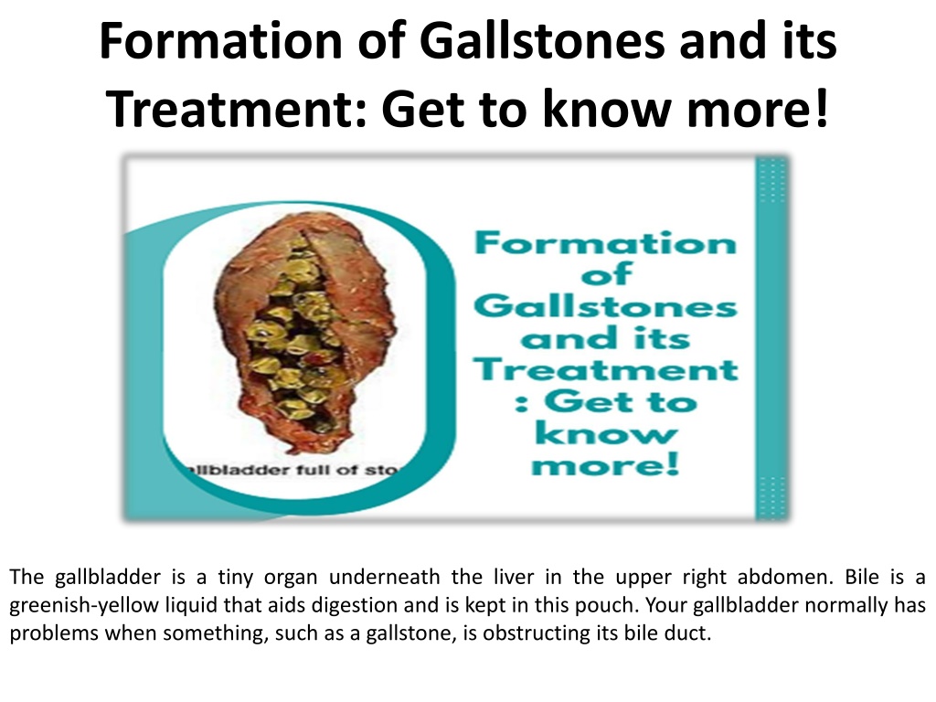 Ppt Gallstones Treatment Find Out More Right Away Powerpoint Presentation Id