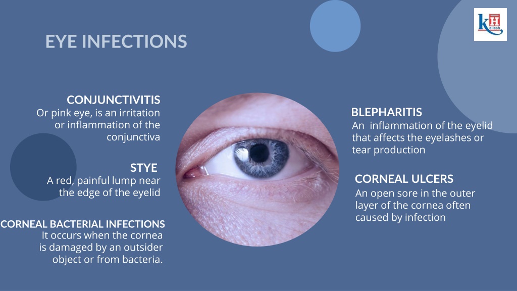 PPT - Discover Symptoms, Damages & Prevention Tips For Eye Infections ...