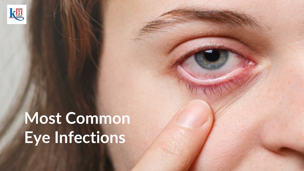 PPT - Discover Symptoms, Damages & Prevention Tips For Eye Infections ...