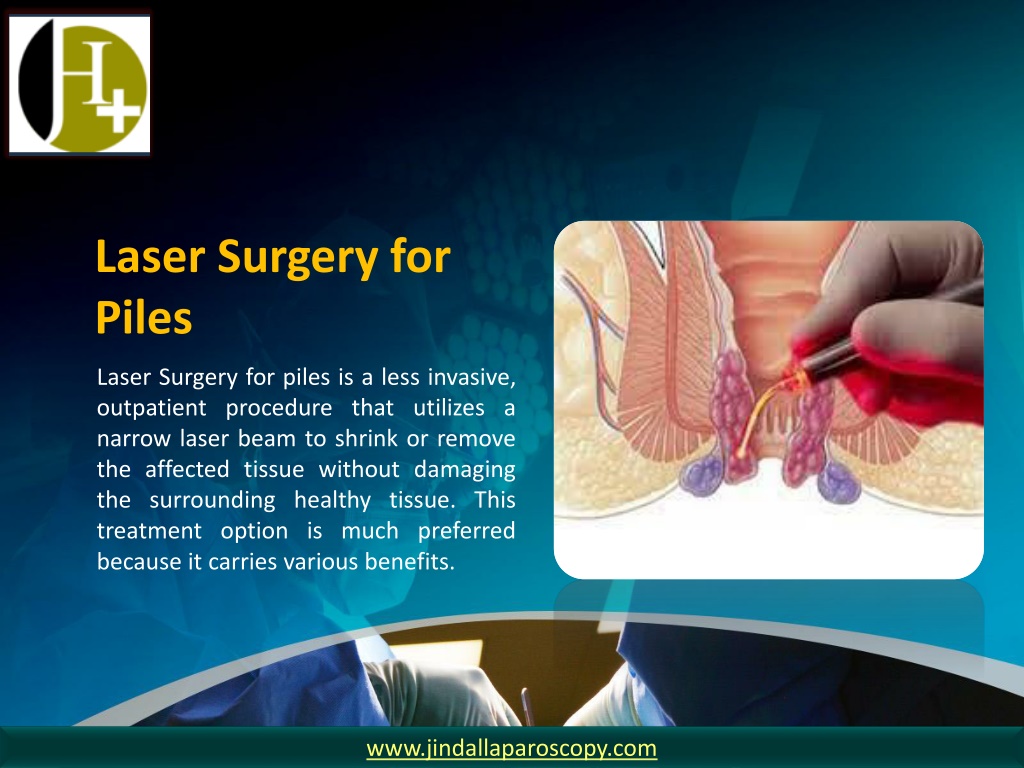 PPT - Advantages & Disadvantages Of Laser Piles Surgery – Dr Jindal ...