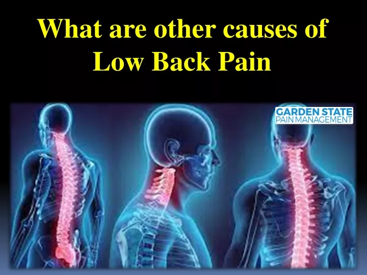 PPT - What are other causes of Low Back Pain PowerPoint Presentation ...