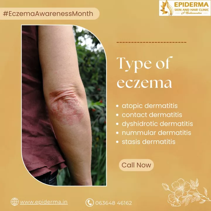 PPT - Types of Eczema | Best Skin Clinic in Jayanagar | Epiderma Clinic ...