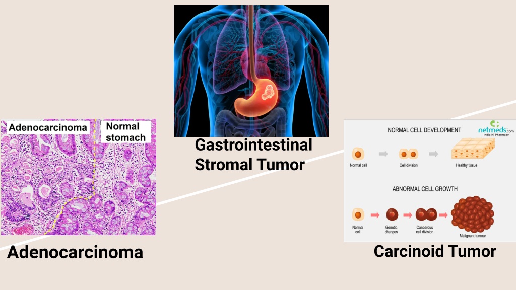 PPT - Best Stomach Cancer Treatment In India PowerPoint Presentation ...