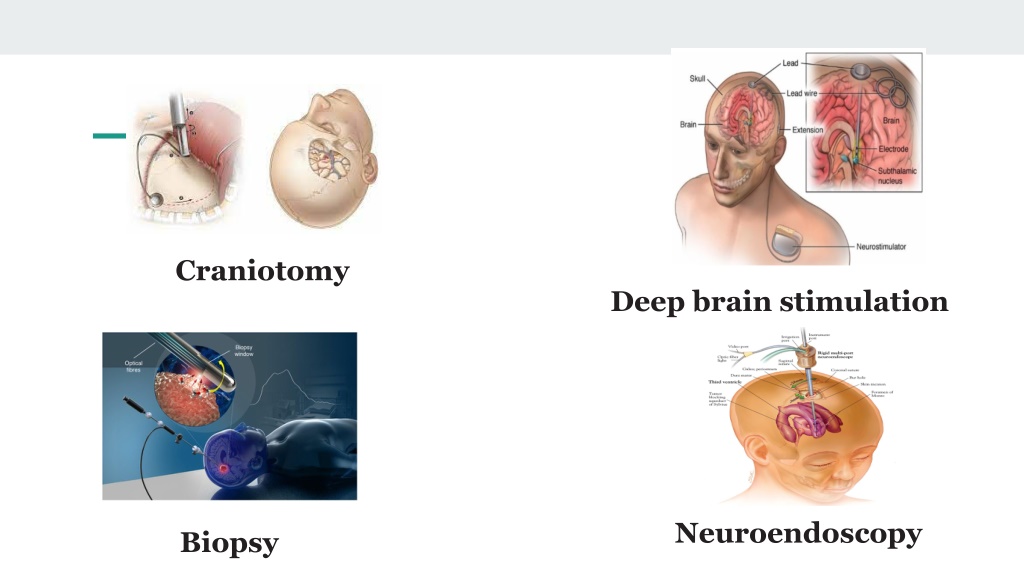 PPT - Best Brain Tumor Surgery In India PowerPoint Presentation, free ...