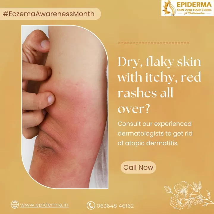 PPT Having dry, flaky skin with itchy Skin Clinic in Jayanagar