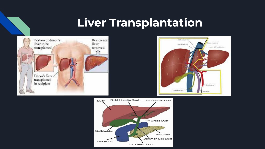 Ppt Liver Transplantation Surgery In India Powerpoint Presentation Free Download Id11712756 9946