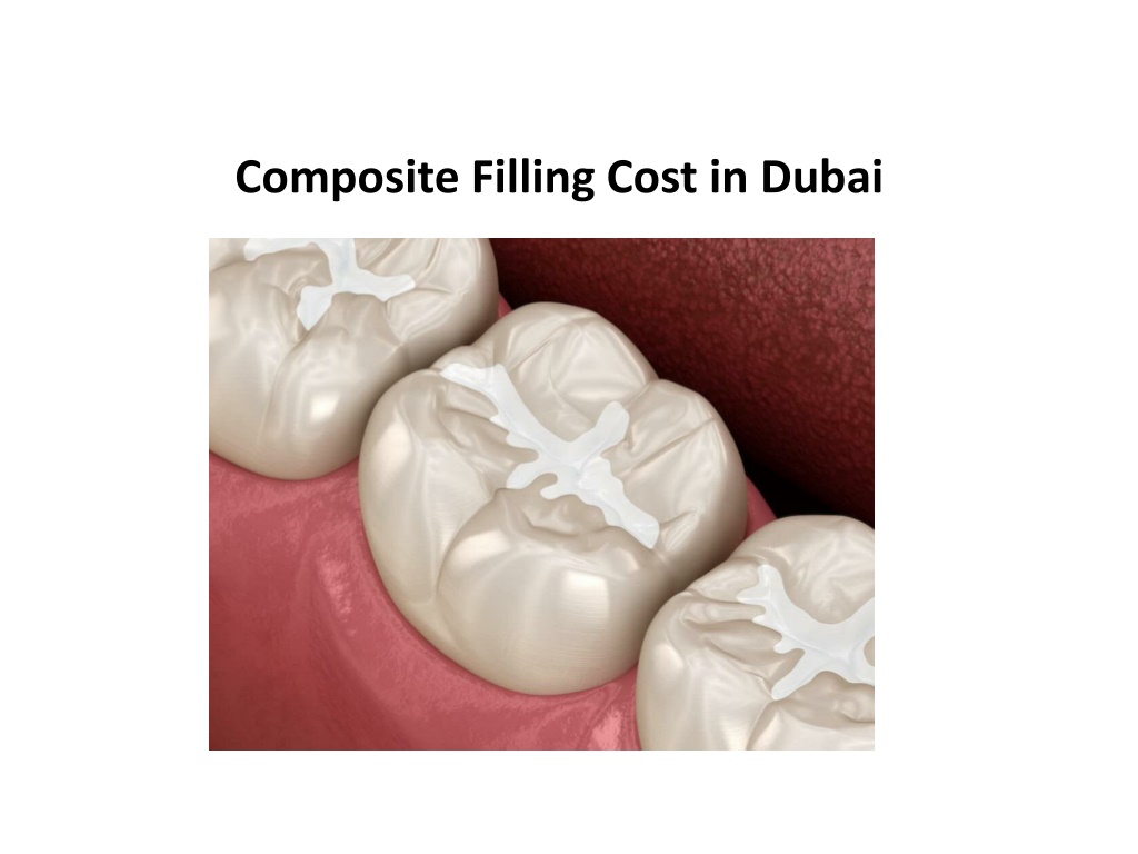 PPT Composite Filling Cost in Dubai PowerPoint Presentation, free