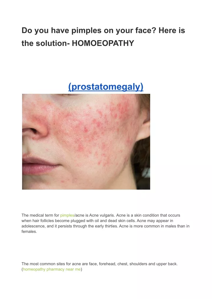 ppt-do-you-have-pimples-on-your-face-here-is-the-solution