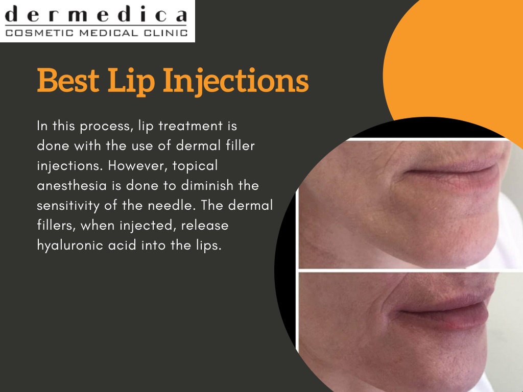 PPT Lip Fillers in Perth PowerPoint Presentation, free download ID11756753