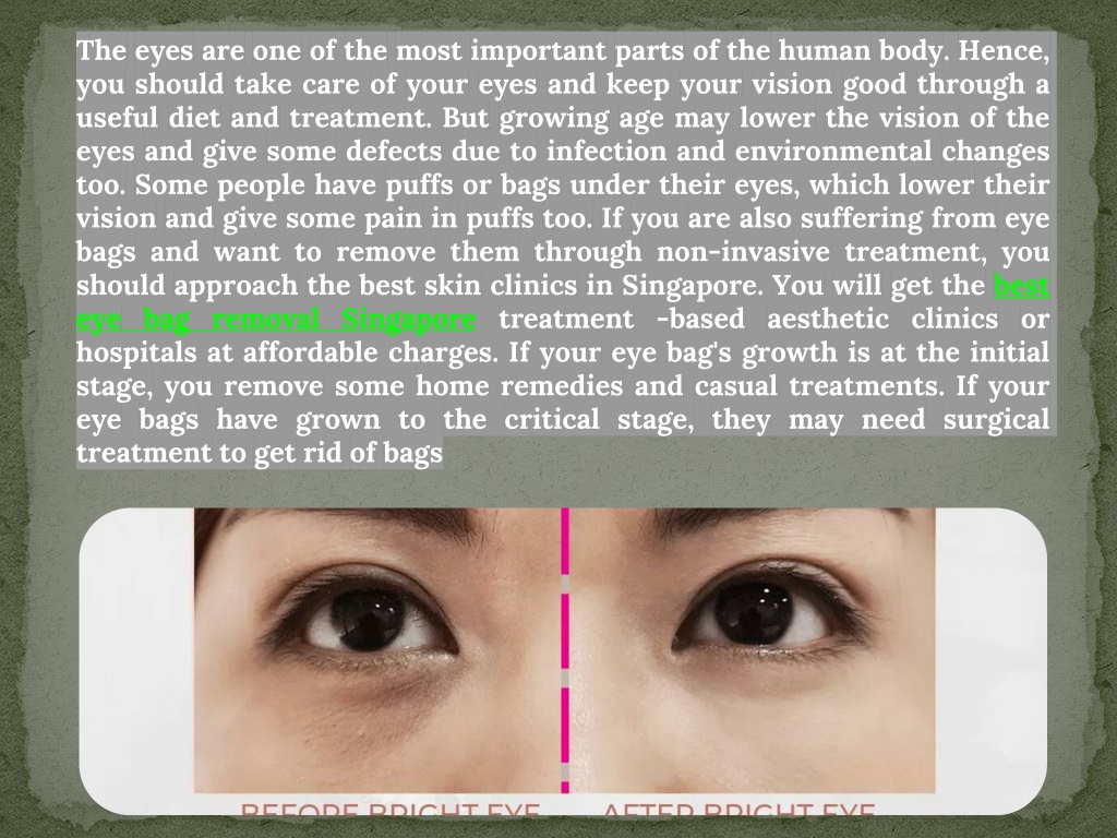 PPT Ultimate Guide On Best Eye Bag Removal Singapore PowerPoint Presentation ID11778303