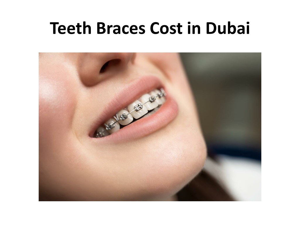 PPT Teeth Braces Cost in Dubai PowerPoint Presentation, free download