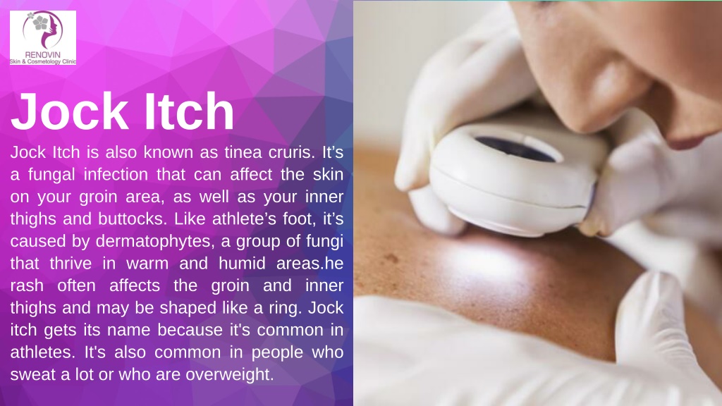 PPT Fungal Infection Specialist Near ME PowerPoint Presentation, free