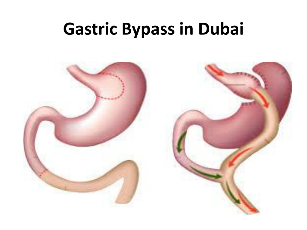 Ppt Gastric Bypass In Dubai Powerpoint Presentation Free Download Id 11797210