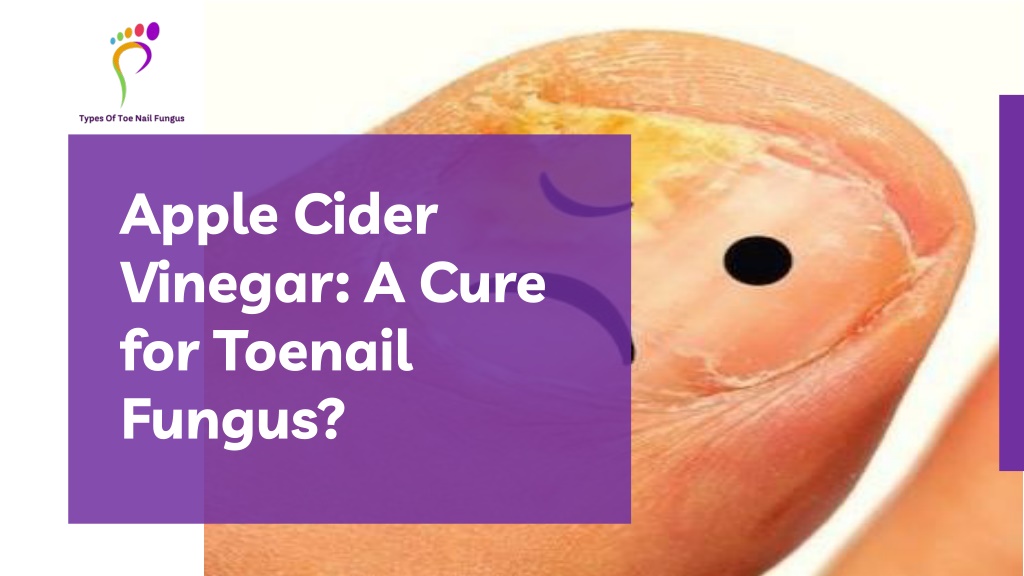 PPT - Apple Cider Vinegar For Toenail Fungus PowerPoint Presentation ...