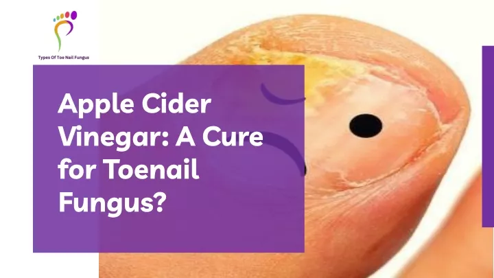 Ppt Apple Cider Vinegar For Toenail Fungus Powerpoint Presentation Free Download Id11803657