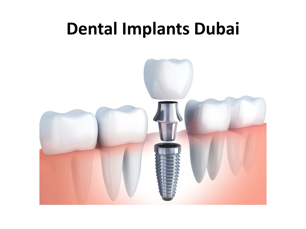 PPT - Dental Implants Dubai PowerPoint Presentation, free download - ID ...