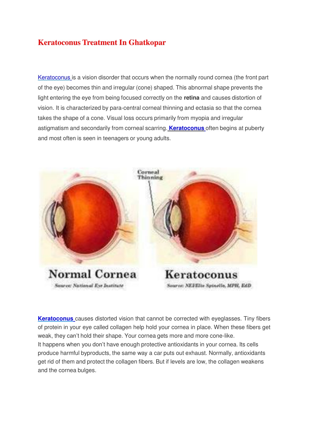 Ppt Keratoconus Treatment In Ghatkopa Powerpoint Presentation Free Download Id