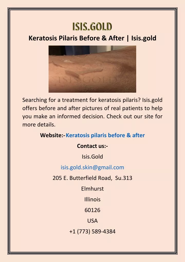 PPT - Keratosis Pilaris Before & After | Isis.gold PowerPoint